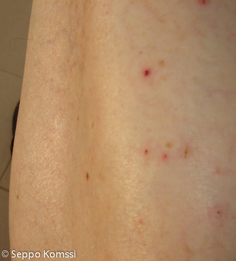 13 cactus spikes in the leg, from Tenerife.